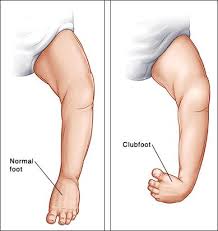 However, treatment is recommended as it can become painful later when the child learns to walk. Club Foot Treatment Surgery Cost In Lagos Find The Best Surgeons Reviews And Book Appointment Africa Infoline