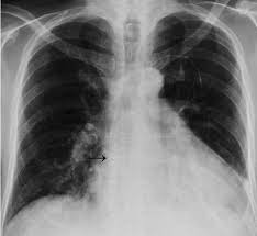 Die implantierbare lenus pro pumpe für die. Periprocedural Safety And Outcome After Pump Implantation For Intravenous Treprostinil Administration In Patients With Pulmonary Arterial Hypertension Bmc Pulmonary Medicine Full Text