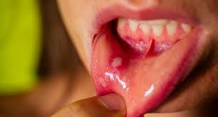 Image result for Oral herpes roof of mouth