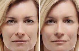 маски для омоложения лица и шеи в домашних условиях Nosogubnye Skladki Prakticheski Nezametny U Molodyh Devushek S Vozrastom Zhe U Mnogih Zhenshin Eti Dve Borozdy Soedinyayushie Krylya Nosa Lico Joga Dlya Lica Krasota