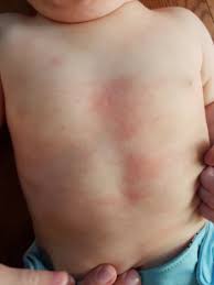 Another Allergy Question Tomatoes September 2019 Birth Club Babycenter Canada