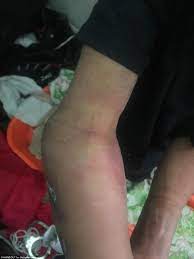 Mummification female autopsy putrefaction of skin after death sloughing of skin from a dead body exfoliation of skin in a dead. Horrific Images Of Tortured Kansas Boy Adrian Jones Daily Mail Online