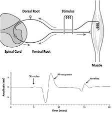 The surgeon uses a sharp instrument to stroke the plantar surface of the foot from lateral to medial, a maneuver that usually results in flexion of all the toes. Emg In Piriformis Syndrome Diagnosis Reliability Of Peroneal H Reflex According To Results Obtained After Surgery Botox Injection And Medical Treatment Journal Of Clinical Neuroscience