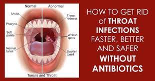 12 Effective Natural Home Remedies To Treat A Strep Throat Infection Throat Infection Throat Remedies Strep Throat