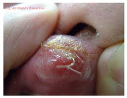 Image result for syphilis ulcer