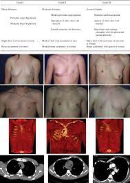 Poland syndrome is a birth defect characterized by an underdeveloped chest muscle and short webbed fingers on one side of the body. Autologous Fat Injection In Poland S Syndrome Journal Of Plastic Reconstructive Aesthetic Surgery