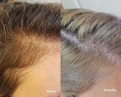 I've seen a youtube tutorial, where an influencer suggested to lightly rub the serum between. Three Month Results The Ordinary Multi Peptide Serum For Hair Density Raiyne On Beauty
