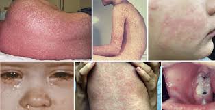 Image result for measles