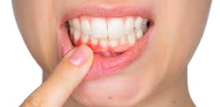 Image result for Gingivitis