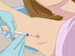 With a needle, tweezers and a mirror, you can easily get rid of ingrown armpit hair at home. 4 Ways To Get Rid Of A Zit On Your Armpit Wikihow