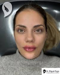 TIR 💉🙌🏻☺️ . 18 meses de diferencia entre la primera y la segunda foto,  una genia mi Paciente 🙏🏻☺️ . Tratamiento Integral del Rostro by Dr. Puga  . Únete a mi canal