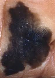 Know the signs and symptoms of melanoma. Melanoma American Skin Association
