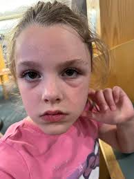 Remedies for wasp stings and allergic reactions