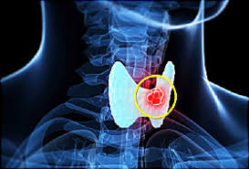 Study flashcards on lymph nodes at cram.com. Papillary Thyroid Carcinoma Symptoms Causes Diagnosis Treatment