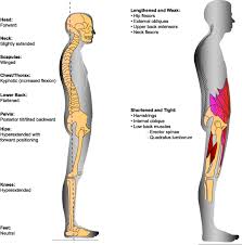 Sway Back Posture Postures Warm Up Routine Muscle Imbalance