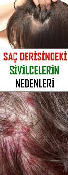 Causes Of Acne In Scalp Causes Haircaretips Scalp Hair Care Akne