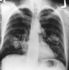 Image result for Chest XRay