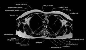The back is subdivided into the upper, middle, and lower back. Chest Anatomy Mri Chest Thorax Axial Anatomy Free Cross Sectional Anatomy