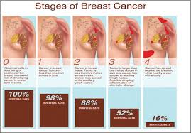 Learn more about breast cancer. Breast Cancer British Journal Of Healthcare Assistants