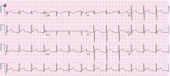The Electrocardiogram In Coronary Artery Disease Springerlink