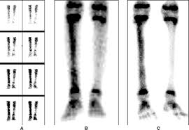 Image result for Osteomyelitis Bone Scan