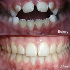 If your front teeth are overlapping your back teeth, ask us. Open Bite Braces Solution With Invisalign Or Appliances Under Bite