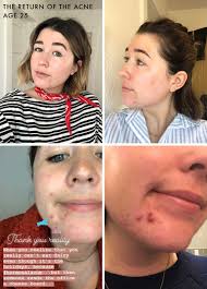 Hormonal acne needs a deeper treatment than topical acne creams can offer. How Sara Saved Her Skin Finally Cured Her Adult Acne Emily Henderson