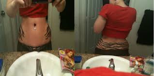 Keloids can have the following characteristics: Are Stretch Marks Permanent Or Reversible Skinpractice