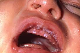 Image result for oral thrush symptoms roof of the mouth