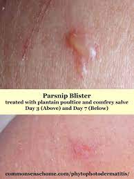 2021 prize is now closed! Phytophotodermatitis Plants That Cause It How To Treat It