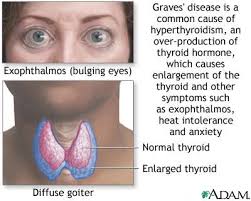 Graves' disease is an immune system disorder that results in the overproduction of thyroid hormones (hyperthyroidism). Grave S Disease Physiopedia