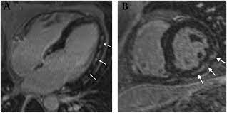 Are you dealing with new onset dillated cardiomyopathy or myocarditis? Cardiac Mri Of Lyme Disease Myocarditis Heart