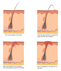 For example, for an upcoming special occasion or event. How To Prevent Ingrown Hairs On Face From Shaving