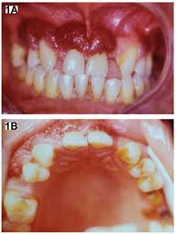 Image result for granuloma gum disease