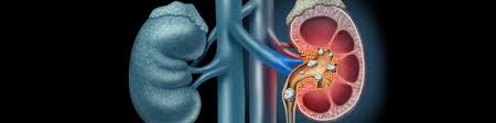 Image result for Nephrolithiasis