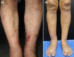 Image result for erythema nodosum