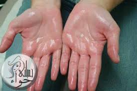 فرط التعرق الاسباب والعلاج بالتفاصيل Excessive Sweating Hyperhidrosis Sweating Too Much