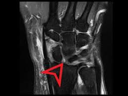 Image result for Scapholunate Dislocation