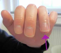 Falls es anzeichen einer fehlstellung gibt, ist der finger vermutlich gebrochen. Knochenbruche Frakturen Zentrum Fur Handchirurgie Nurnberg