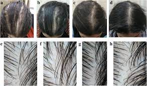 Here's what you need to know. Trichogenic Effect Of Topical Ketoconazole Versus Minoxidil 2 In Female Pattern Hair Loss A Clinical And Trichoscopic Evaluation Biomedical Dermatology Full Text