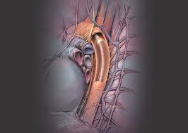 The device supports the main pumping chamber (left ventricle) by moving blood to the rest of the body. Intravascular Microaxial Lvad Vs Iabp During Pci For Ami With Cardiogenic Shock The Cardiology Advisor