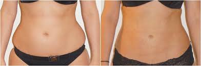 Love Handles Liposuction Male Liposuction Love Handles Love Handles Liposuction Lipo Before And After