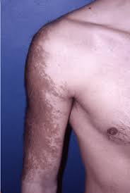 Image result for Macule