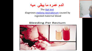 Image result for Modified Apt Test