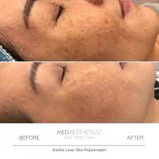 When treating freckles or sunspots with the revlite, you can expect some redness around the treated lesion. Revlite Si Skin Rejuvenation