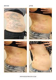 I just came back from my 1st visit at blink tattoo removal, and it was great. Before And After Photos For Patient 8752 Body Recon