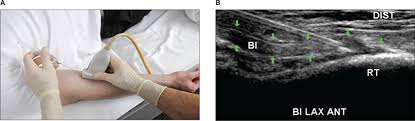 Image result for Biceps Tendon Injection