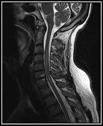 It results from damage to nerve cells in a certain area. Longitudinally Extensive Transverse Myelitis In A Patient Infected With West Nile Virus Multiple Sclerosis And Related Disorders