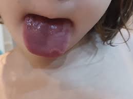 Image result for Puchýře na jazyku