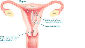 Iud S Mirena Kyleena Skyla Paragard Wellesley Ma Near Boston Ma